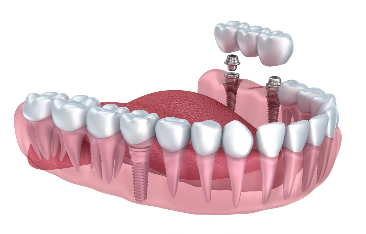 Multiple Teeth Implant Dentist in Barrhead & Neilston
